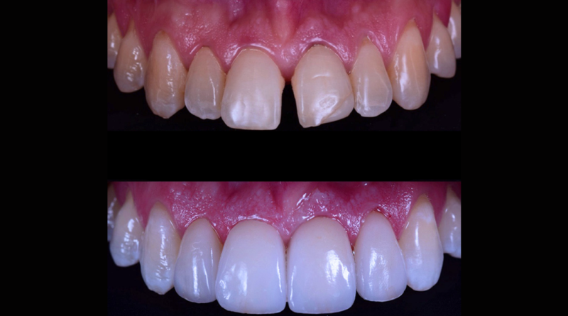 Lentes de contato dental podem ser aplicadas em restaurações