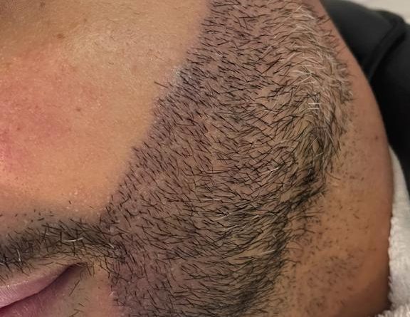 Transplante de barba cresce no mercado masculino