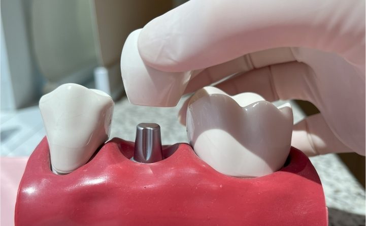 Cresce busca por implantes dentários com tecnologia digital