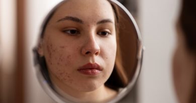 Acne se torna cada vez mais comum entre mulheres adultas