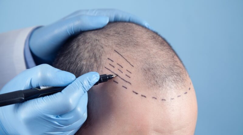 Tecnologia visa mais naturalidade em transplante capilares