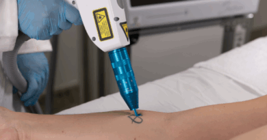 Procura por remoção de tatuagens cresce no Brasil