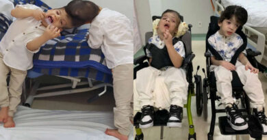 Após nove cirurgias, gêmeos siameses são separados com sucesso: “É um milagre”