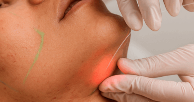 Laser subdérmico surge como alternativa à lipoaspiração