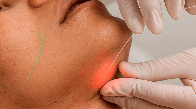 Laser subdérmico surge como alternativa à lipoaspiração