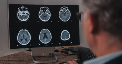 Setembro é o mês de conscientização do aneurisma cerebral