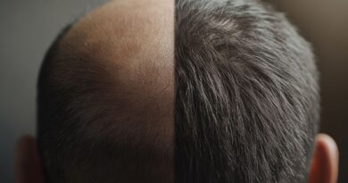 Demanda por transplante capilar valoriza resultados naturais