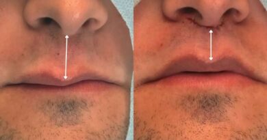 Lip Lift amplia opções de rejuvenescimento sem volume