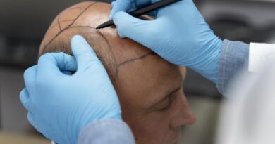 Técnica FUE redefine padrões de transplante capilar moderno