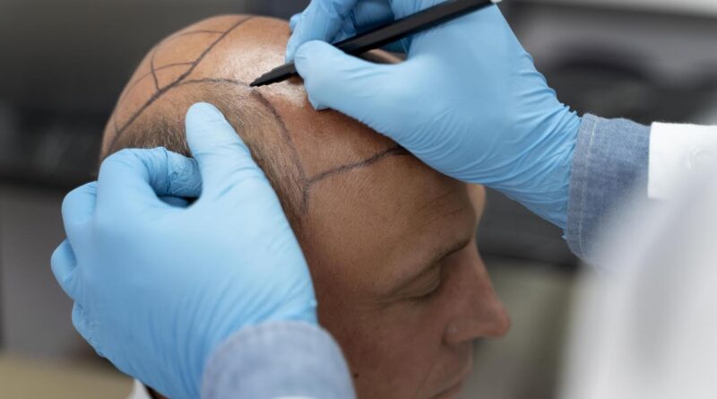 Técnica FUE redefine padrões de transplante capilar moderno