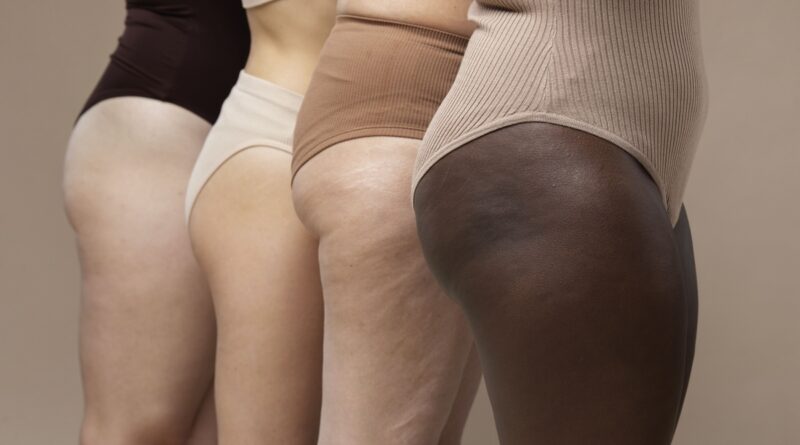 Lipedema vai além da estética e pode ter relação hormonal