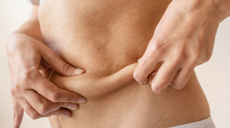 Tecnologia melhora retração da pele após lipoaspiração