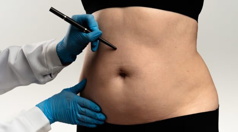 Lipoaspiração lidera preferência por cirurgias plásticas