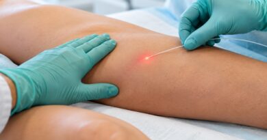 Laser permite tratar a safena sem retirar a veia da perna