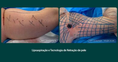 Tratamento remove flacidez do braço com tecnologia associada