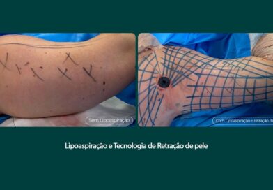 Tratamento remove flacidez do braço com tecnologia associada