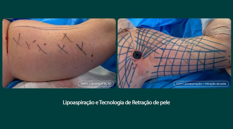 Tratamento remove flacidez do braço com tecnologia associada