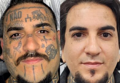 Remoção de tatuagem cresce e muda perfil de quem procura